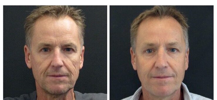 Sculptra Before After